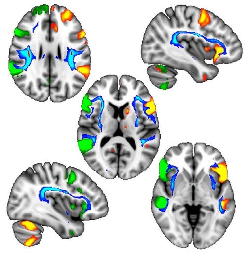 左撇子的基因优势清单（左撇子是基因突变吗）